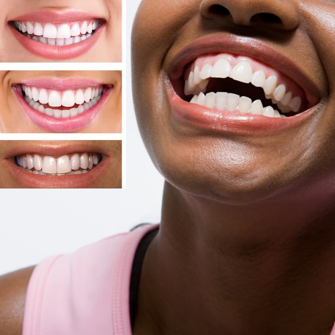 Kit de blanchiment des dents Glorysmile (Togo) – allcaal