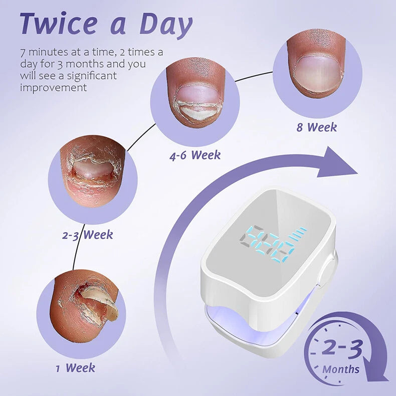 Laser pour mycoses des ongles (Chad)